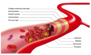 Hypertension