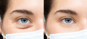 blepharoplasty in riyadh