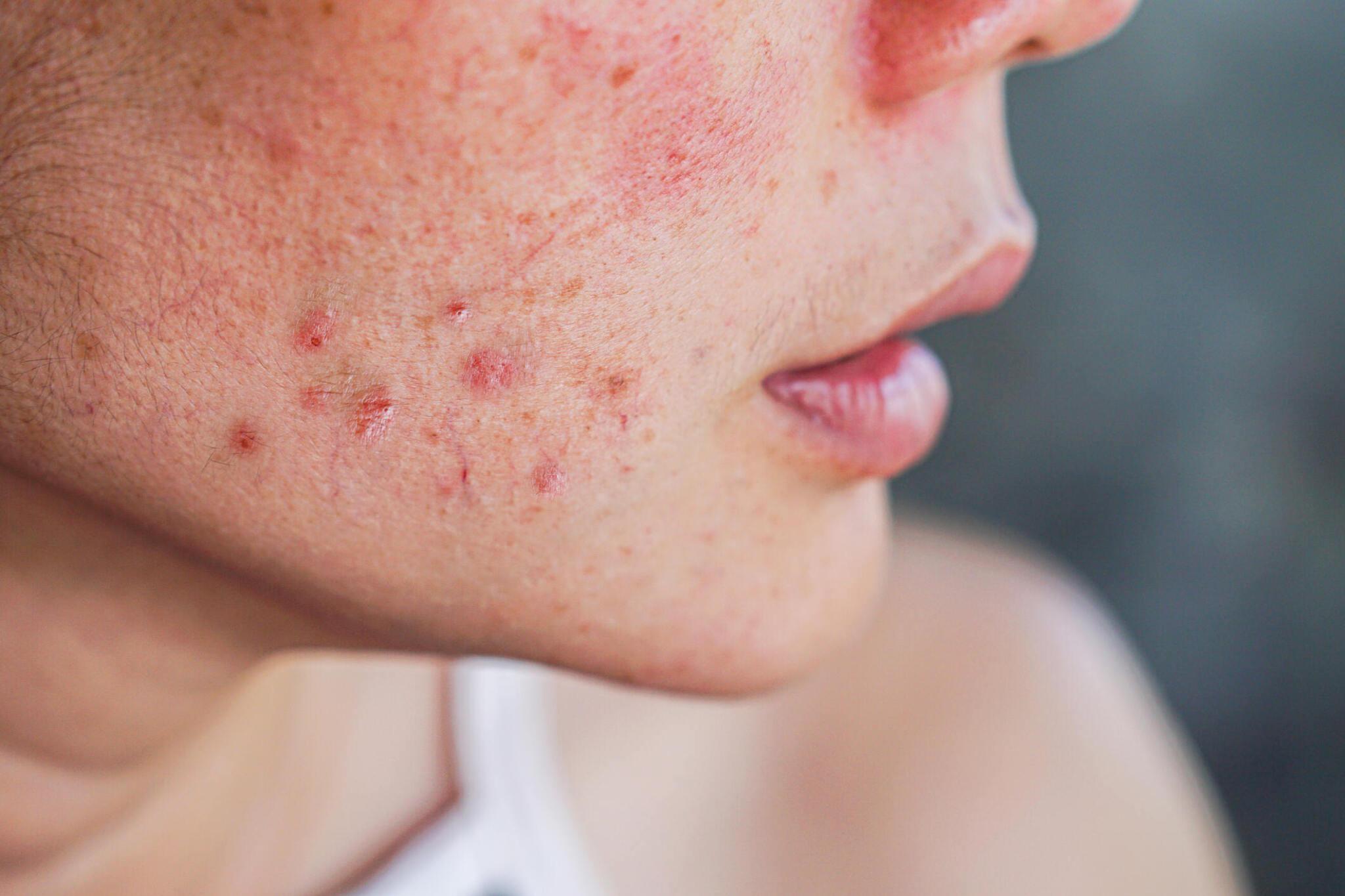 Hormonal Therapy for Acne Effectiveness and Safety