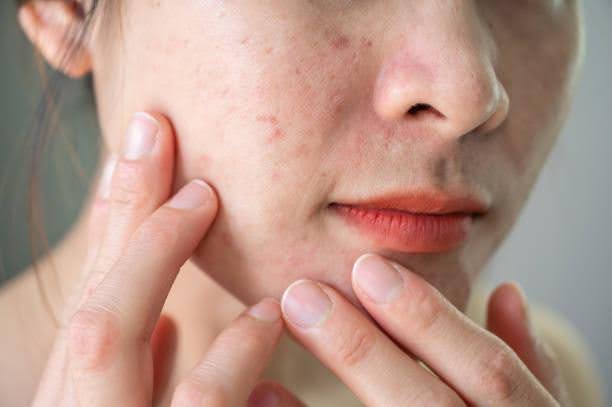 How-Long-Does-Hormonal-Acne-Last