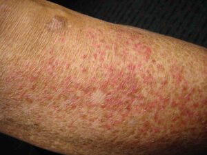 asteatotic eczema