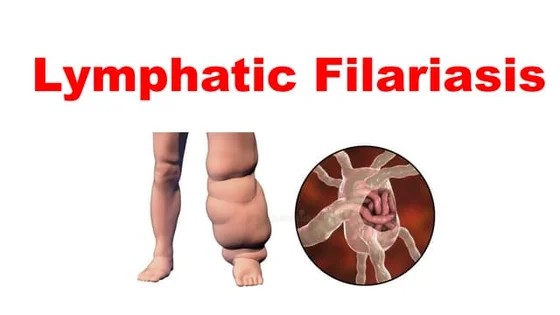 Filariasis