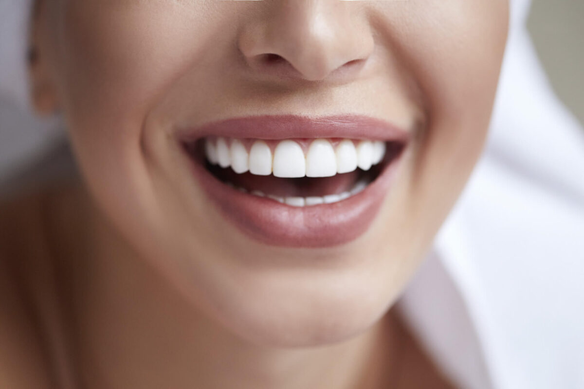 5 facts you should know about teeth whitening