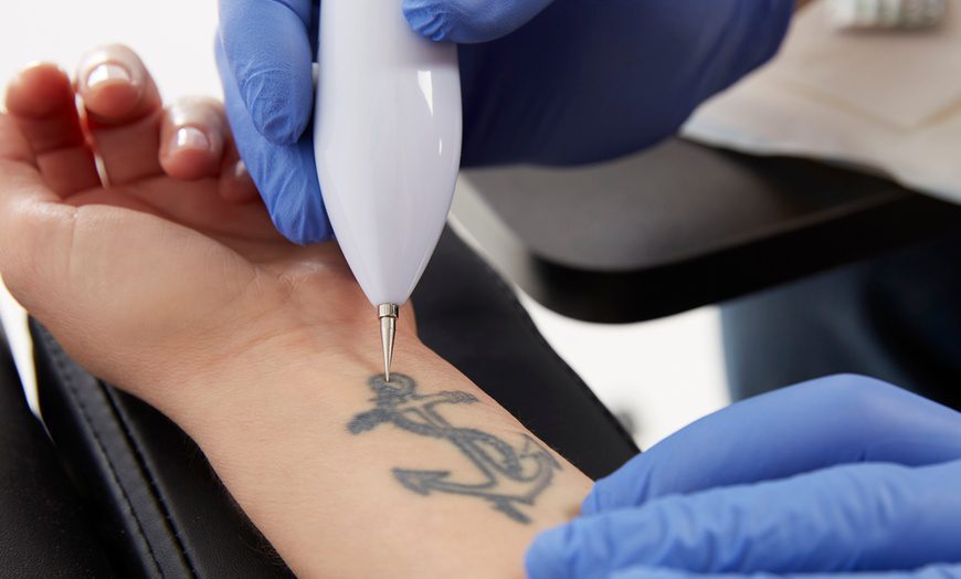 How Saline Tattoo Removal in Orlando Offers a Natural Solution for Unwanted Tattoos?