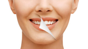 How to Whiten Your Teeth and Improve Your Smile | Dentist Davie