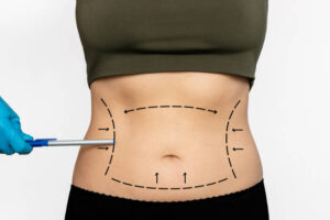 Vaser 4D liposuction in Abu Dhabi