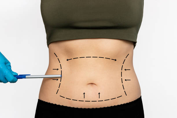 Vaser 4D liposuction in Abu Dhabi