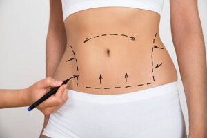 liposuction in Abu Dhabi