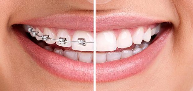 the benefits of braces more than just straight teeth