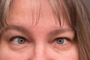 lazy eye treatment for adults