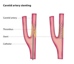 Carotid Artery Stenting