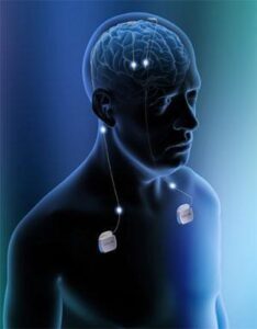 Deep Brain Stimulation