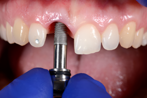 dental implants