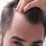 Hair Transplant in Riyadh