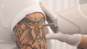 Laser Tattoo Removal