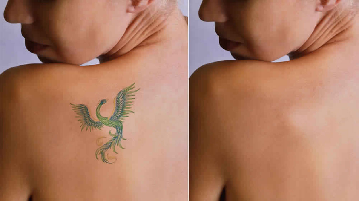 Tattoo Removal