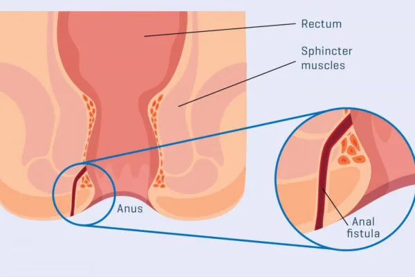 Fistula Surgeon Mumbai