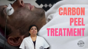 Carbon Peel laser treatment