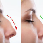 Rhinoplasty Surgery in Dubai: What to Expect Before, During, and After the Procedure