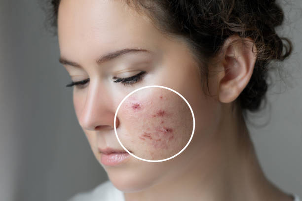 Acne Laser Treatment Cost in Dubai