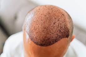 Hair Transplant in Riyadh