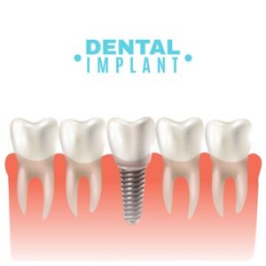 best dental implant clinic in kochi