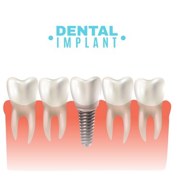 best dental implant clinic in kochi