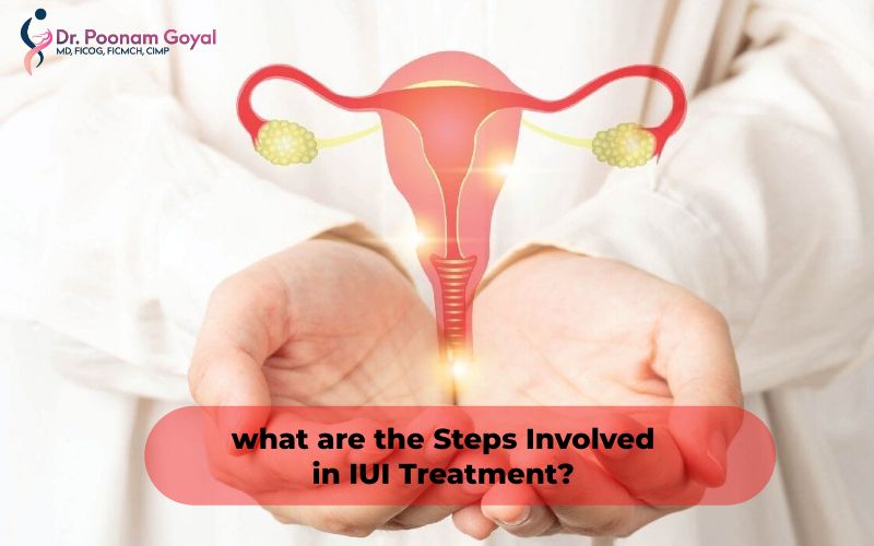 Understanding the Steps Involved in IUI Treatment