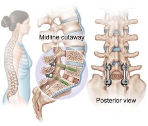 spine fusion surgery