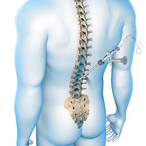 disc bulge in the spine