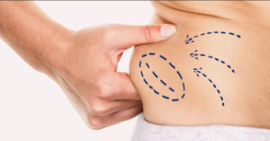 Liposuction in Dubai