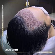 Hair Transplant in Riyadh