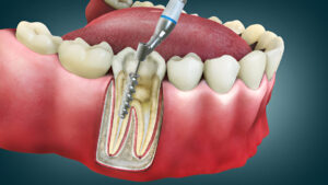 What Services Can You Expect from Root Canal Specialists at Heritage Dental in San Antonio, TX?