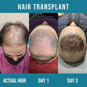 Hair transplant in pakistan